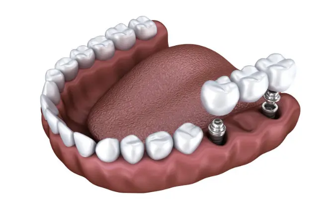 Dental Implants