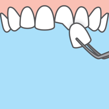 Chipped Tooth Repair