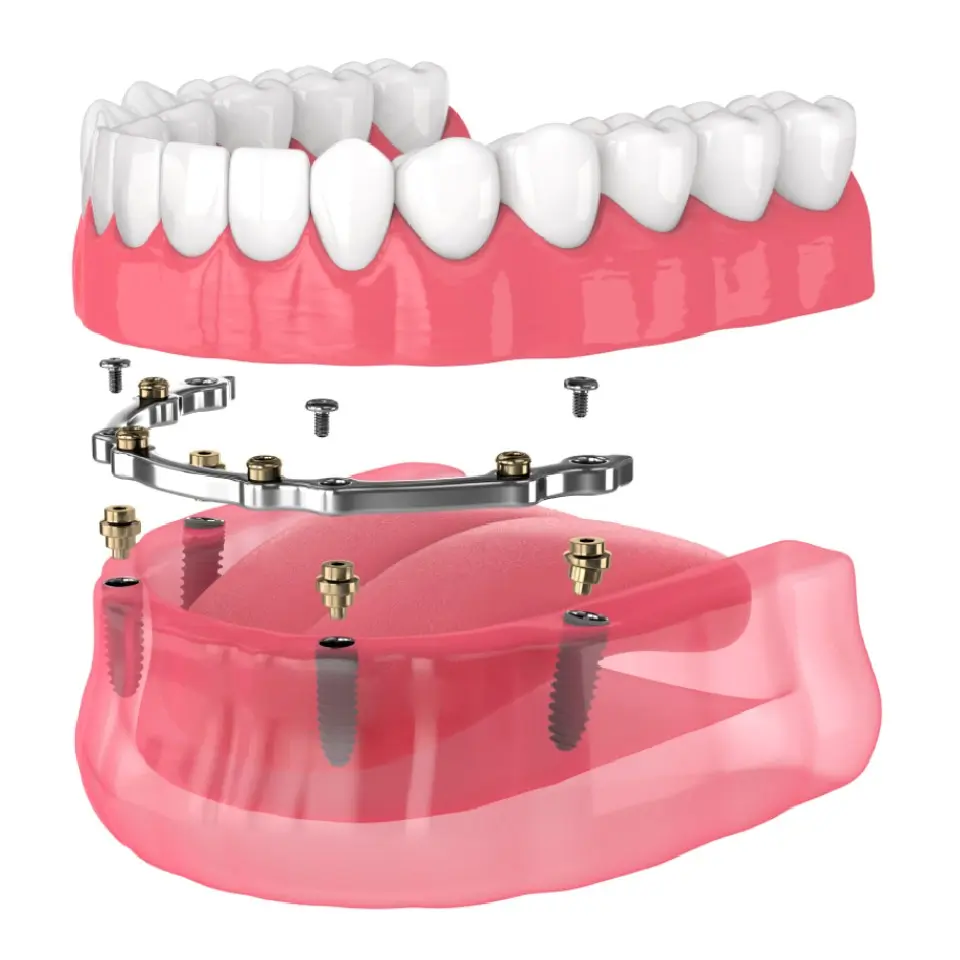 Dental Implants