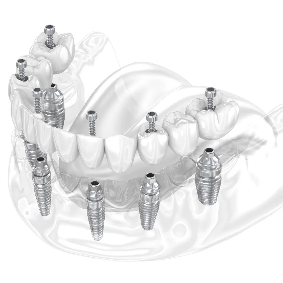 Dental Implants