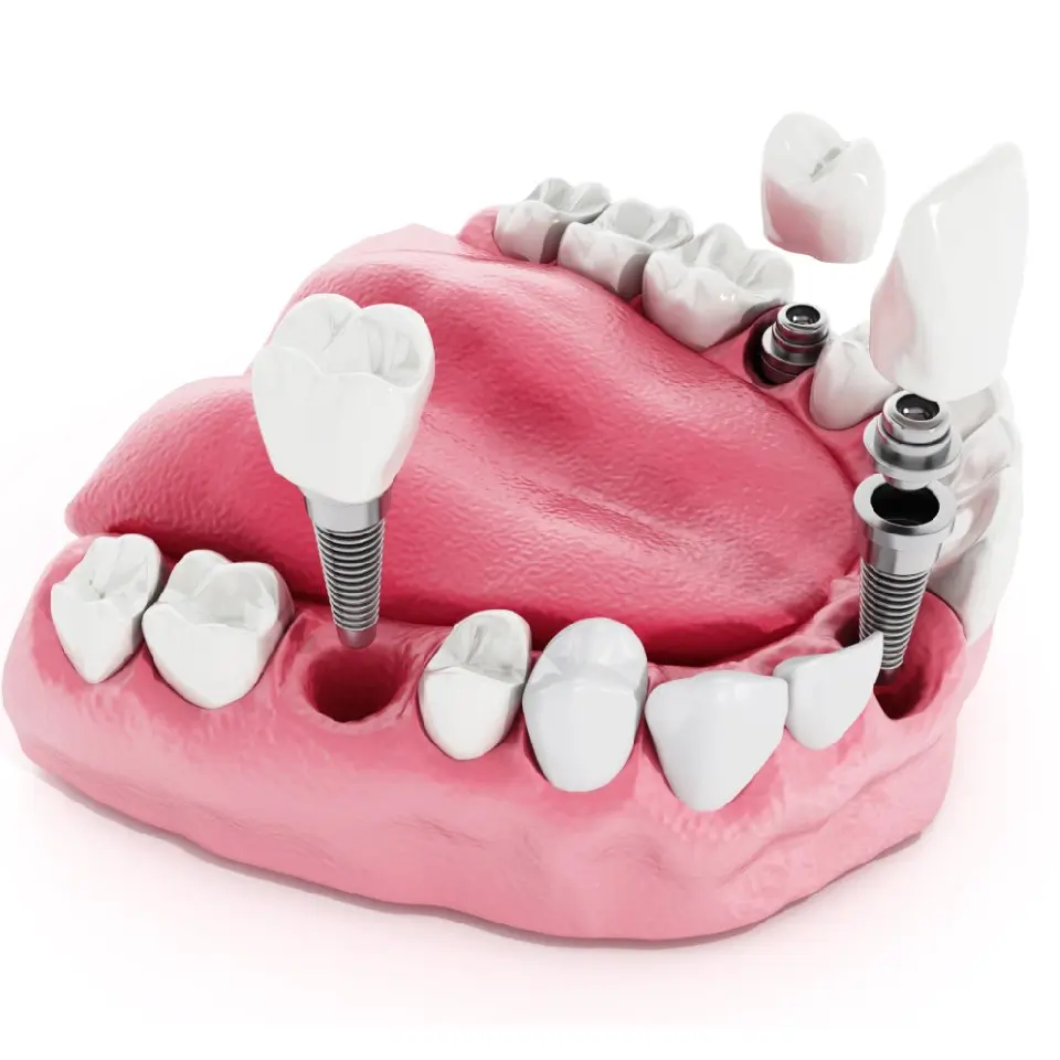 Dental Implants