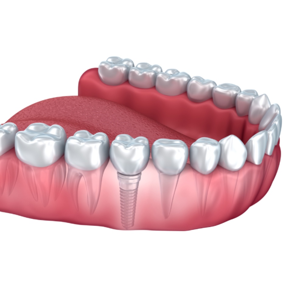 Dental Implants